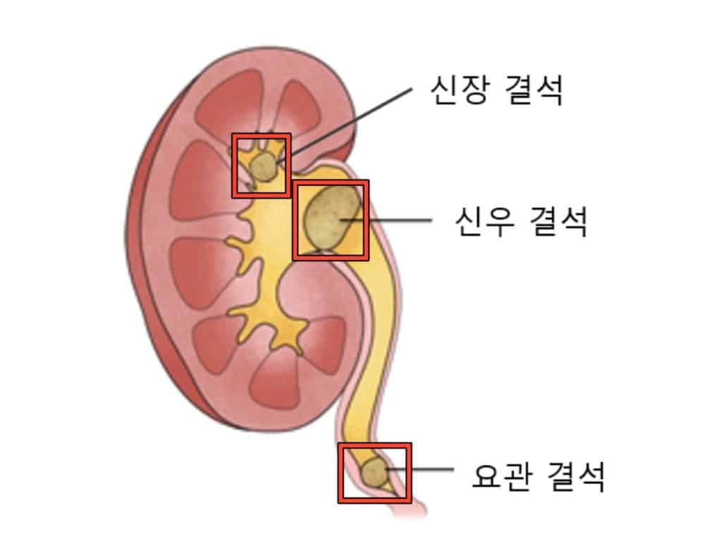 요로결석